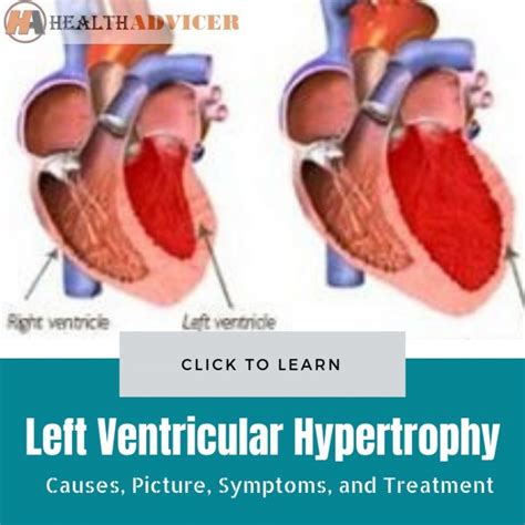 left ventricular hypertrophy symptoms treatment.